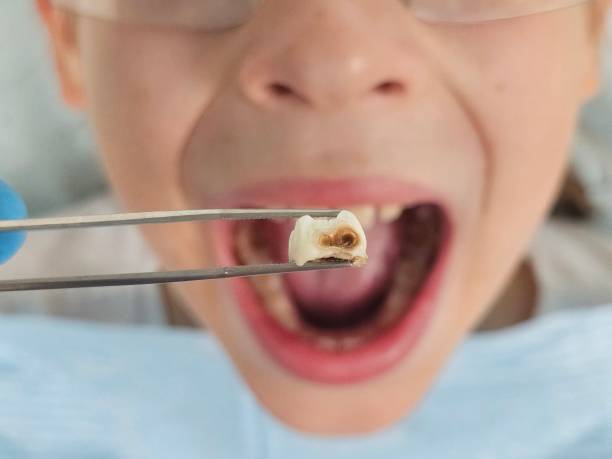 Best Knocked-Out Tooth (Avulsed Tooth) Treatment in Prospect Park, NJ